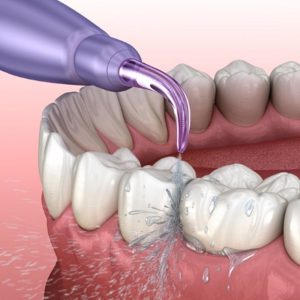 واترجت دندان چه ویژگی هایی دارد؟