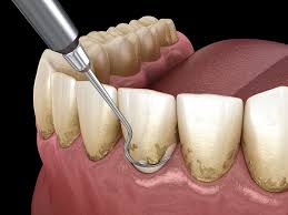 نکاتی در مورد فواید جرم گیری دندان